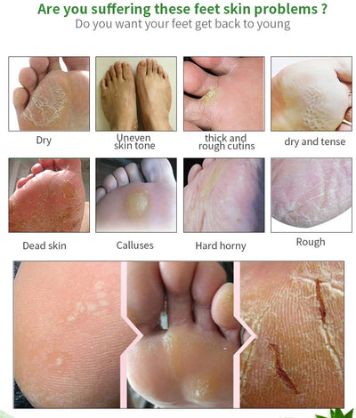 Foot peelmask